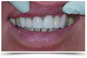 Photo of teeth after smile makeover
