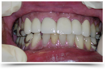 Photo of teeth after smile makeover