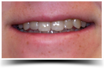 Photo of before smile makeover